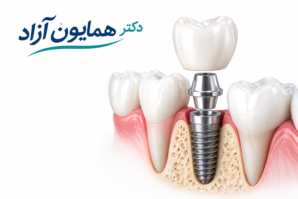 بهترین ایمپلنت در شهرکرد ، دکتر همایون آزاد