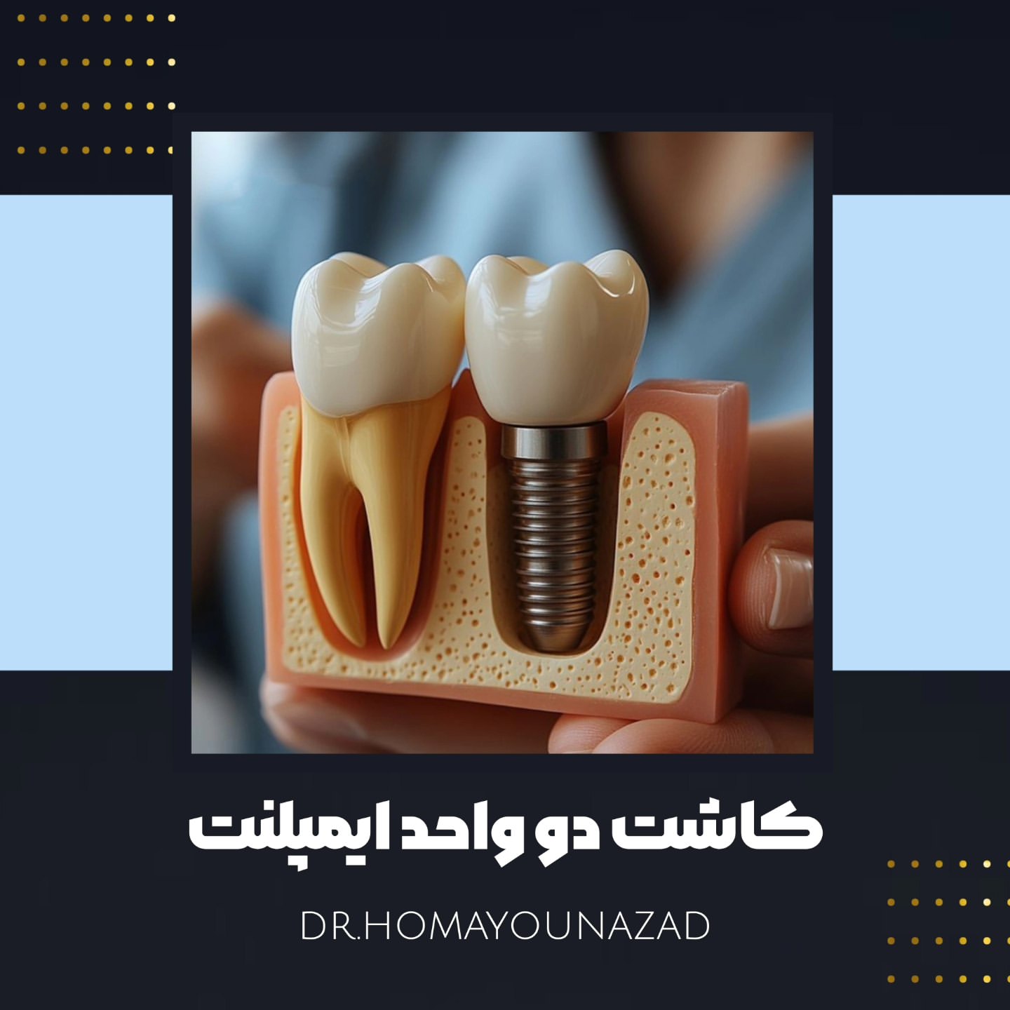 ایمپلنت شهرکرد
